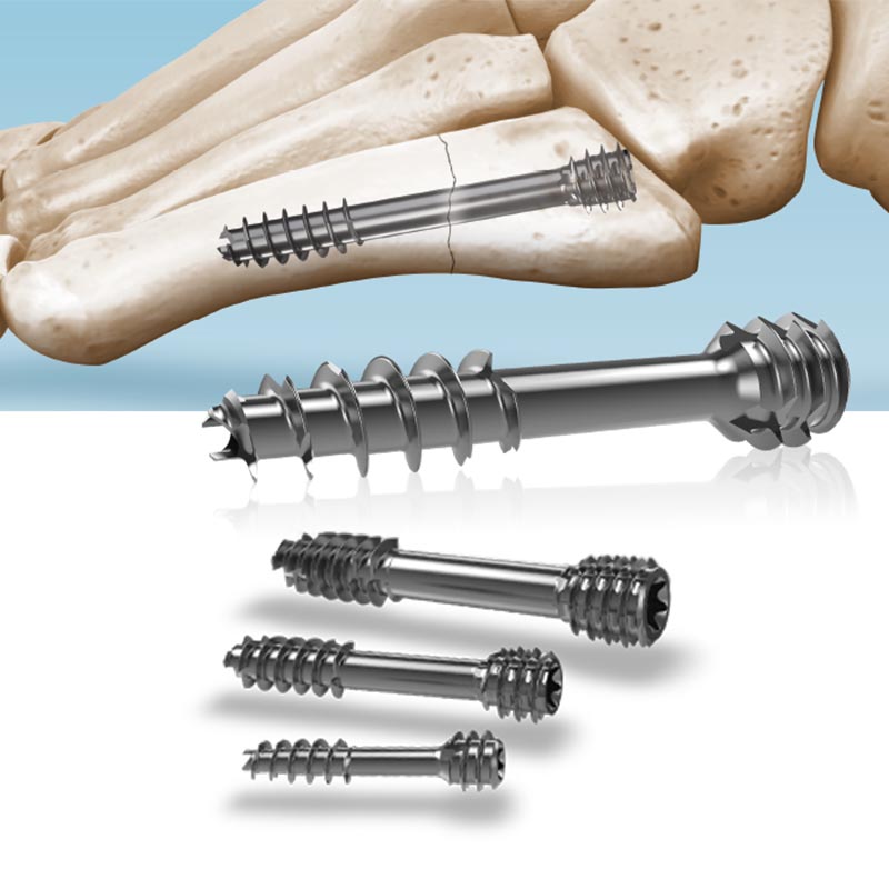 Compression Screw Sizes