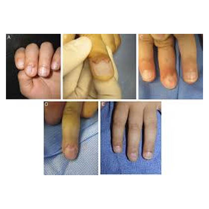 Figure 3 from Nail Plate and Bed Reconstruction for Pincer Nail Deformity |  Semantic Scholar