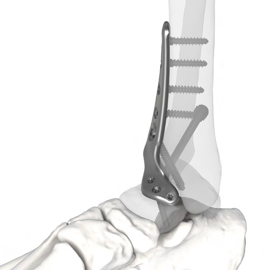 NeoFuse Ankle Plating System – eXmedical